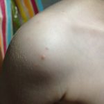 molluscum contagiosum